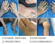 痛风中期症状患者需重视