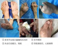 痛风发展到晚期易导致残疾