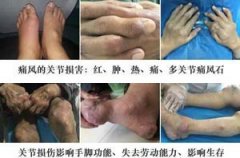 专业解析：原发性痛风有哪些表现