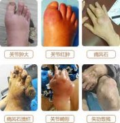 生活中预防痛风合理的方式有哪些?