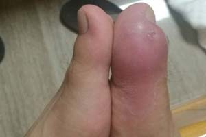患者双脚拇趾对比明显.jpg
