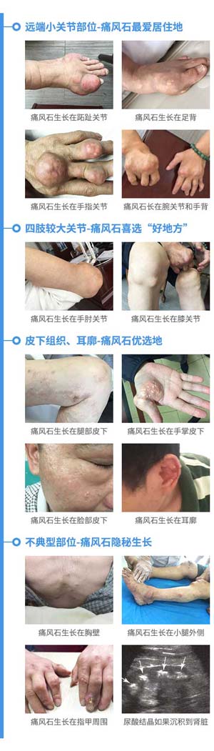 痛风石的侵害部位,常规检查难以辨认.jpg