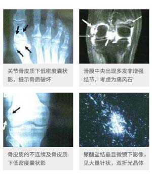 精确化检查,提前定位病灶及时掌控痛风石病况.jpg